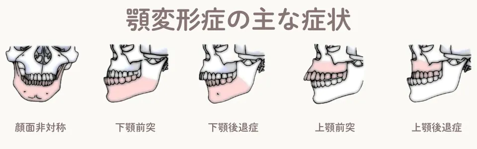 顎変形症（がくへんけいしょう）とは