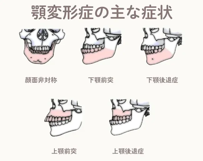 顎変形症（がくへんけいしょう）とは