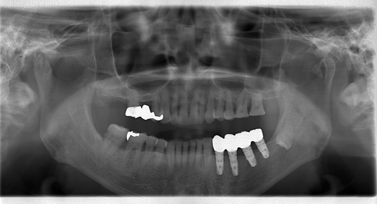 症例⑥　インプラント埋入（複数歯）