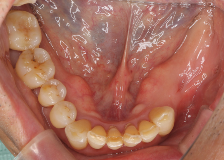 症例⑥　インプラント埋入（複数歯）