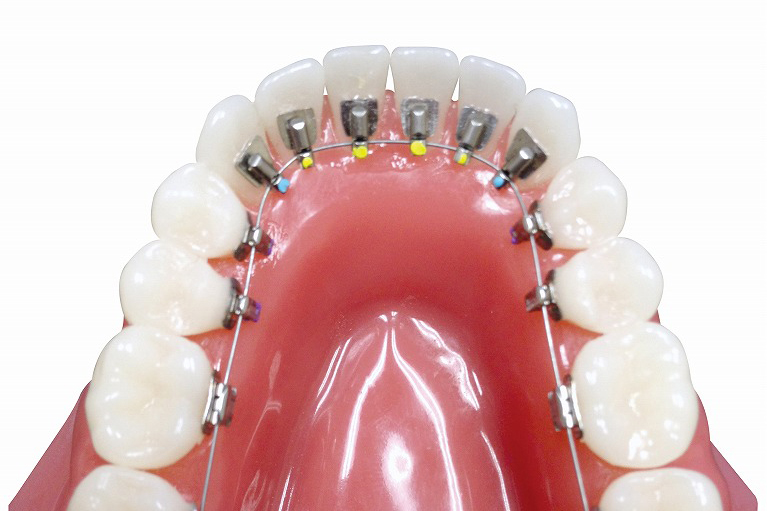 リンガルブラケット矯正装置（アリアス）【舌側矯正】