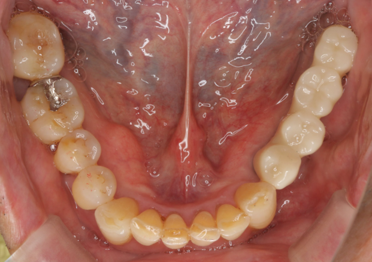 症例⑥　インプラント埋入（複数歯）